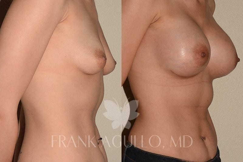 Breast Augmentation Before and After 2