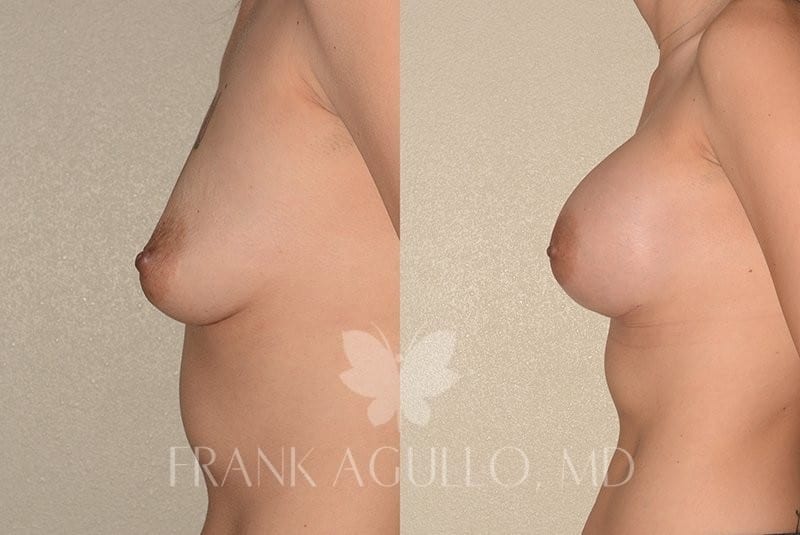 Breast Augmentation Before and After 5