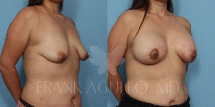 Breast Lift Before and After 4