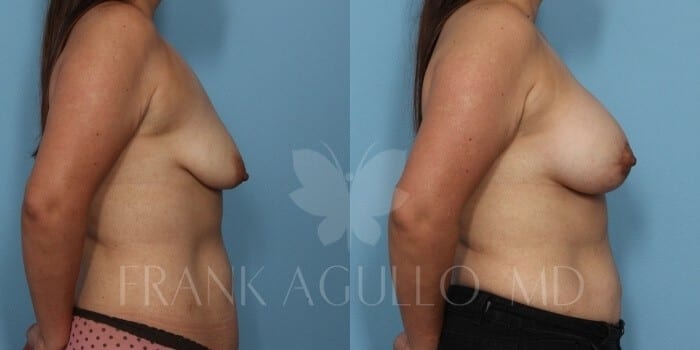 Breast Lift Before and After 5