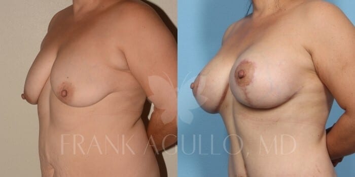 Breast Before and After 1