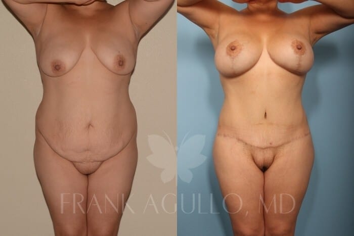 Breast Lift Before and After 2