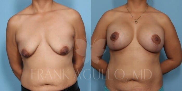 Breast Lift Before and After 18