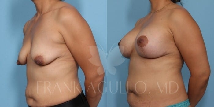 Breast Lift Before and After 2