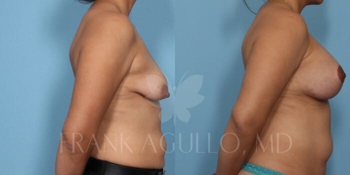Breast Lift Before and After 5