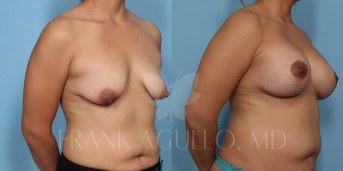 Breast Lift Before and After 6