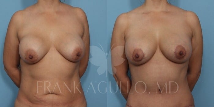 Breast Lift Before and After 2
