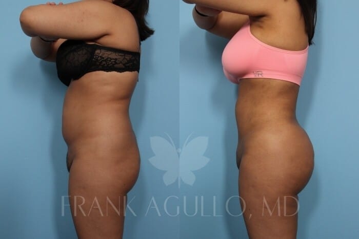 Brazilian Butt Lift Before and After 7