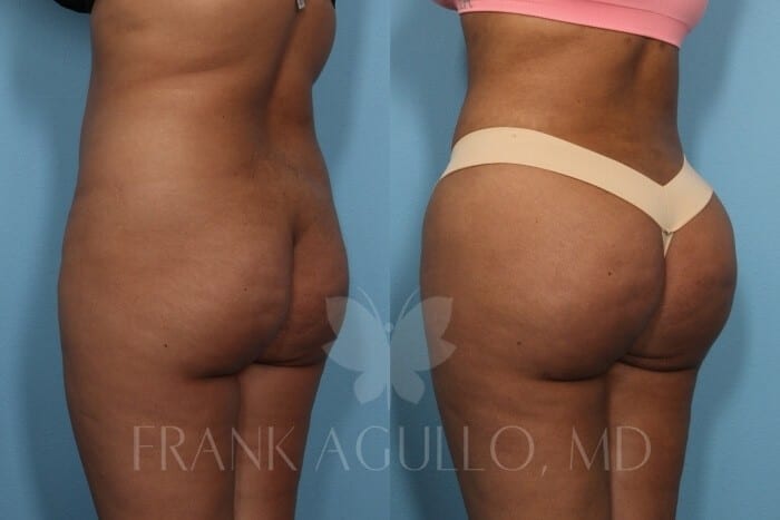 Brazilian Butt Lift Before and After 2