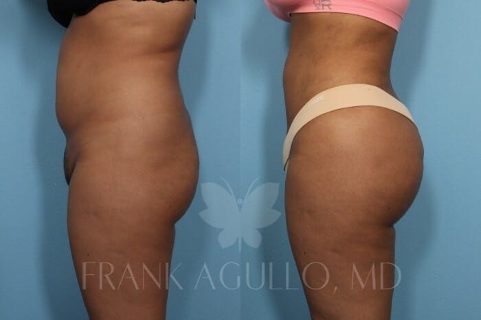 Brazilian Butt Lift Before and After 3
