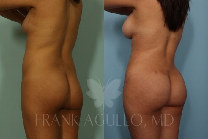 Butt Implants Before and After 2