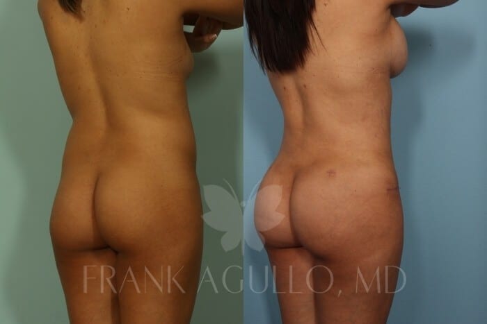 Butt Implants Before and After 3