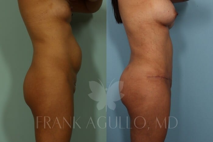 Butt Implants Before and After 4