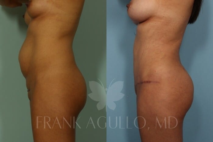 Butt Implants Before and After 5