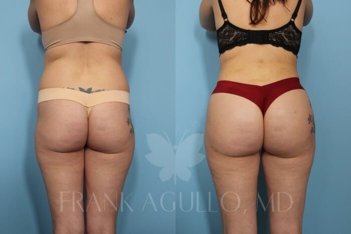 Brazilian Butt Lift Before and After 6