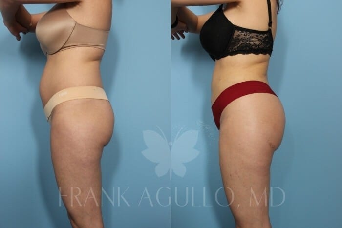 Brazilian Butt Lift Before and After 2