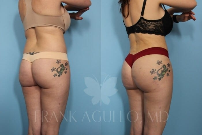 Brazilian Butt Lift Before and After 4