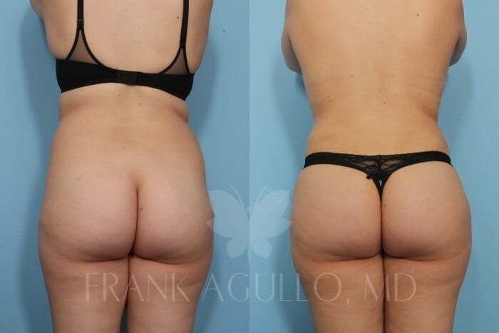 Brazilian Butt Lift Before and After 5