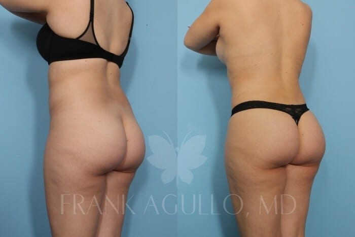Brazilian Butt Lift Before and After 3