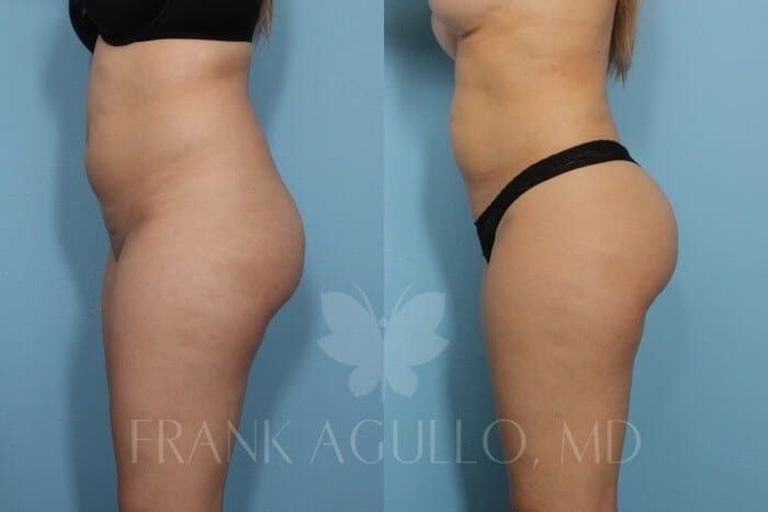 Brazilian Butt Lift Before and After 4