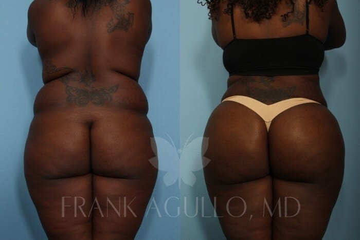 Brazilian Butt Lift Before and After 4