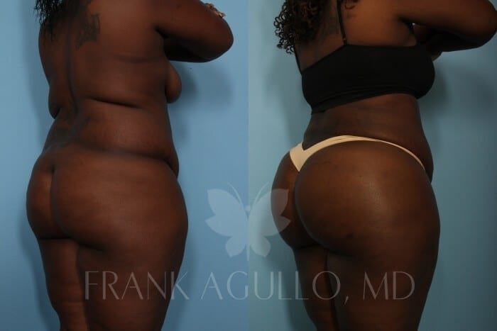 Brazilian Butt Lift Before and After 2