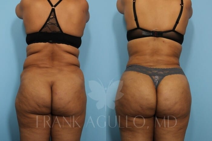 Brazilian Butt Lift Before and After 3