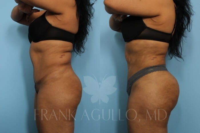 Brazilian Butt Lift Before and After 2