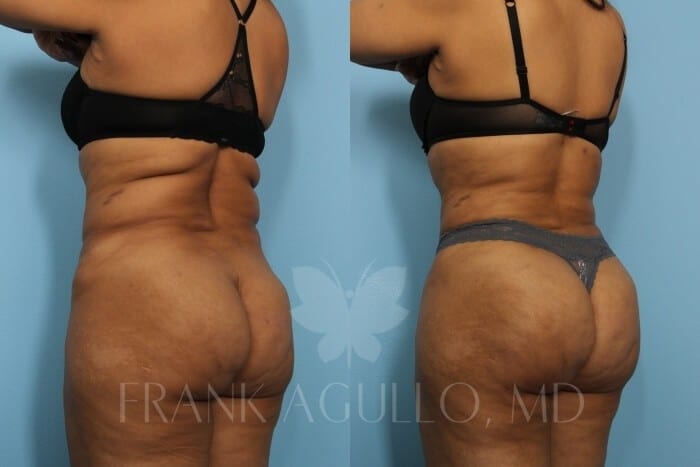 Brazilian Butt Lift Before and After 4