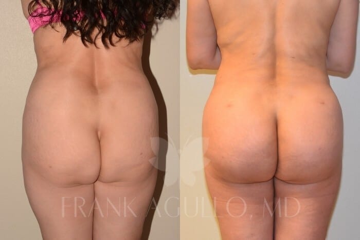 Brazilian Butt Lift Before and After 7