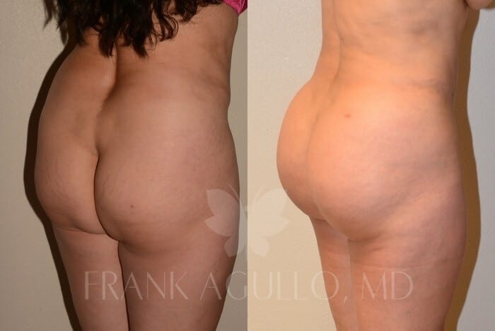 Brazilian Butt Lift Before and After 2