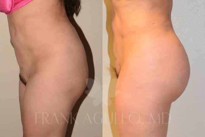 Brazilian Butt Lift Before and After 3