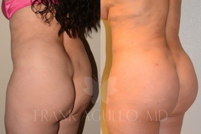 Brazilian Butt Lift Before and After 5