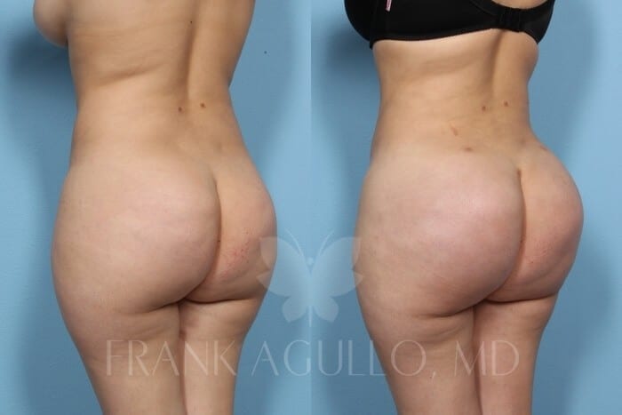 Brazilian Butt Lift Before and After 3