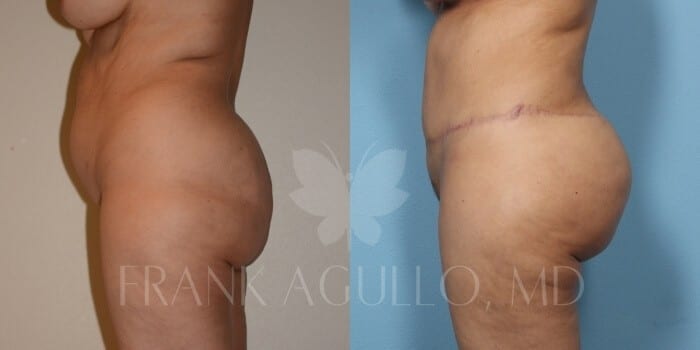 Brazilian Butt Lift Before and After 5