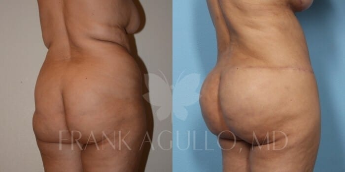 Brazilian Butt Lift Before and After 2