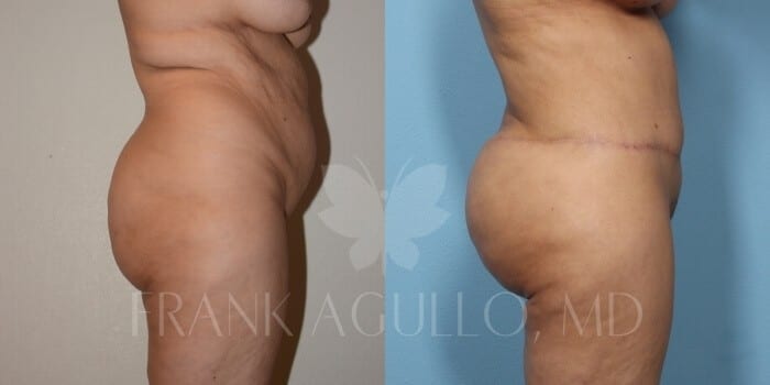 Brazilian Butt Lift Before and After 3