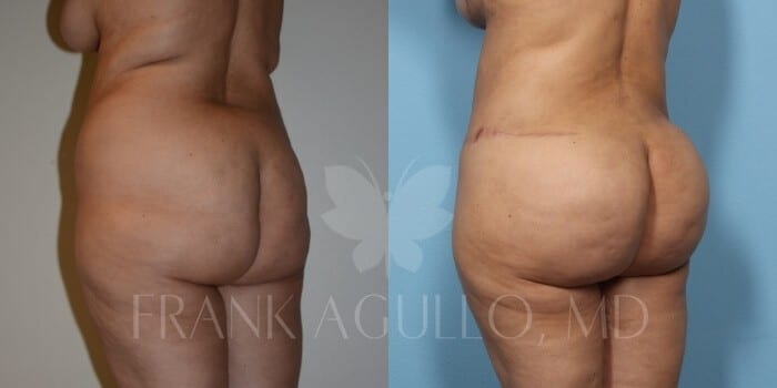 Brazilian Butt Lift Before and After 4