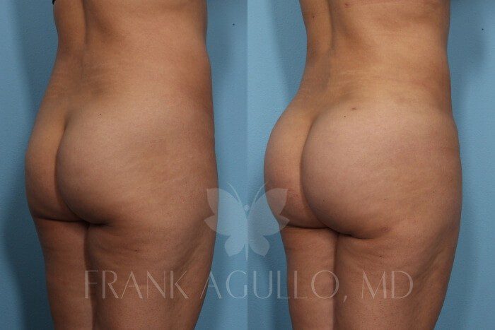 Brazilian Butt Lift Before and After 13
