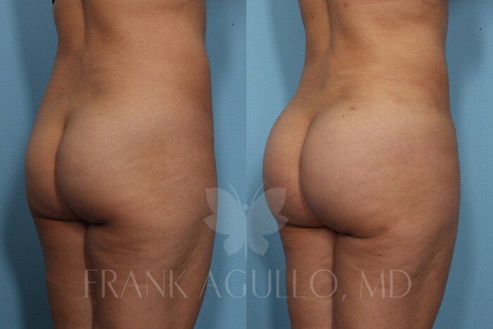 Brazilian Butt Lift Before and After 4