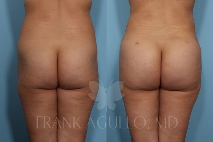 Brazilian Butt Lift Before and After 2