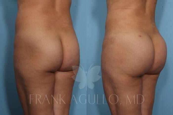 Brazilian Butt Lift Before and After 3