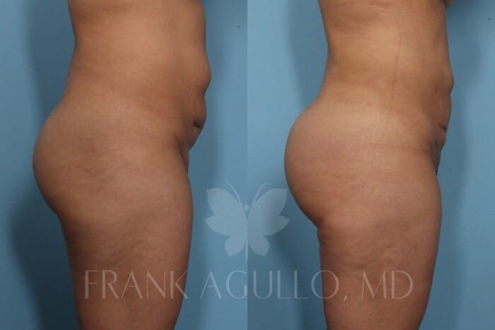 Brazilian Butt Lift Before and After 5