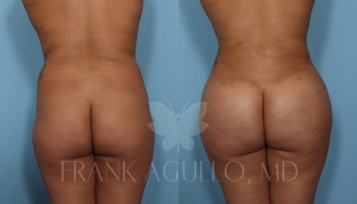 Brazilian Butt Lift Before and After 2