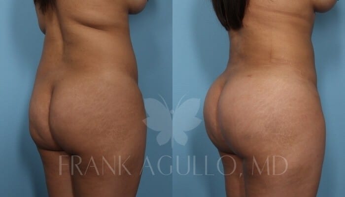 Brazilian Butt Lift Before and After 4