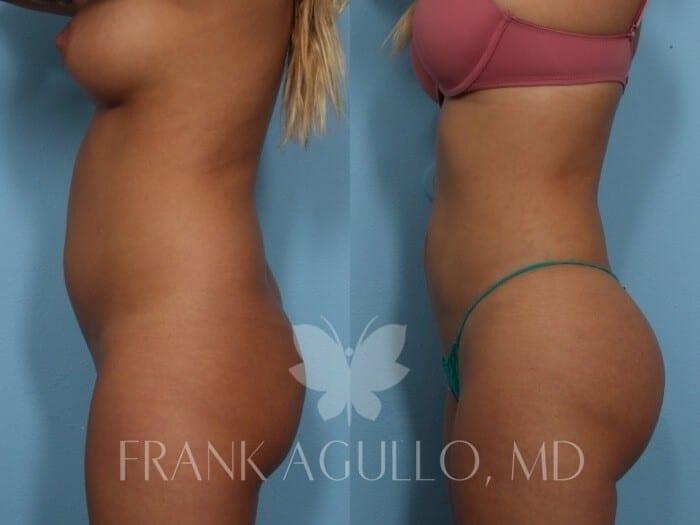 Brazilian Butt Lift Before and After 10