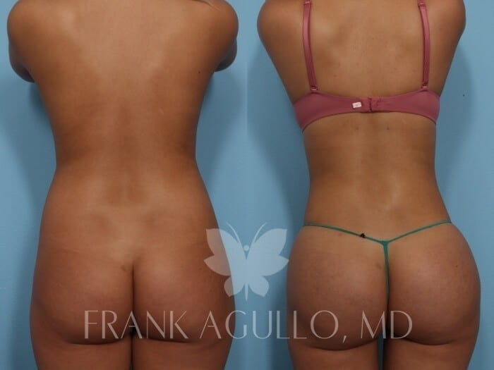Brazilian Butt Lift Before and After 2