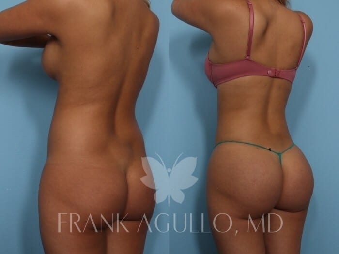 Brazilian Butt Lift Before and After 3