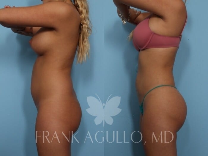 Brazilian Butt Lift Before and After 5