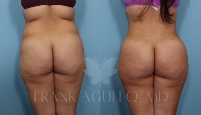 Brazilian Butt Lift Before and After 9